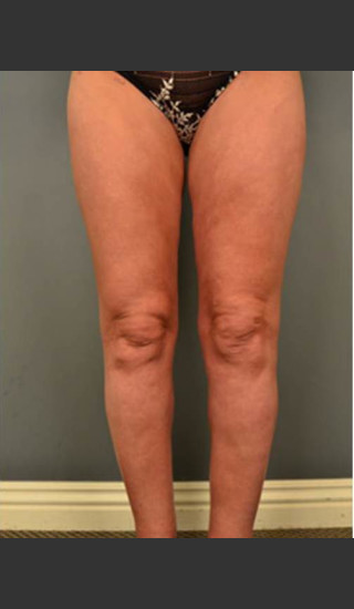 After Photo for Circumferential Liposuction #46 - Dr. David Amron - Prejuvenation