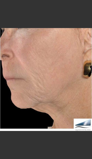 After Photo for Infini Rhytides and Facial Laxity Treatment -  - Prejuvenation