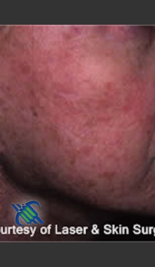 Before Photo for Treatment of Right Cheek Pigmentation - Roy G. Geronemus, M.D. - Prejuvenation