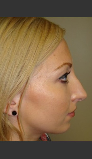 Before Photo for Rhinoplasty 6574 - Sanjay Grover MD FACS - Prejuvenation