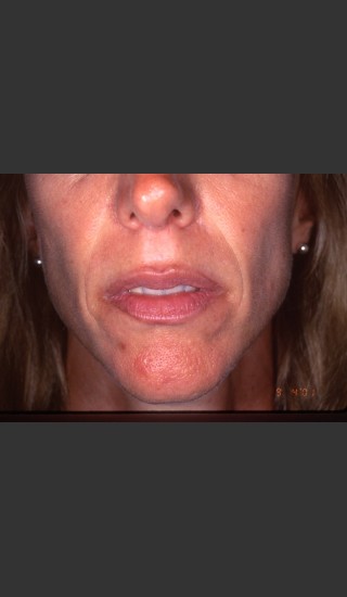 After Photo for Treatment of Permanent Lip Liner - Roy G. Geronemus, M.D. - Prejuvenation