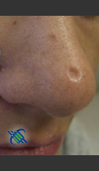 Before Photo for Treatment of Nose Acne Scar - Roy G. Geronemus, M.D. - Prejuvenation