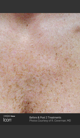 Before Photo for Skin Revitalization of Chest Using Icon -  - Prejuvenation