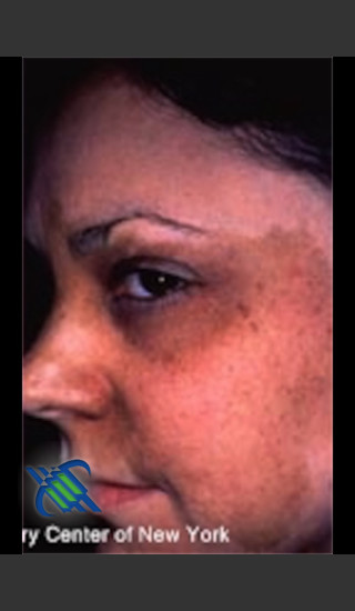 After Photo for Treatment of Facial  Cafe au Lait - Roy G. Geronemus, M.D. - Prejuvenation