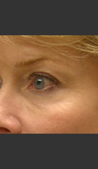 After Photo for Dr. Langdon ThermiSmooth  - Robert Langdon - Prejuvenation