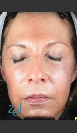 After Photo for Treatment of Left Side Hyperpigmentation - Brian D. Zelickson, M.D. - Prejuvenation