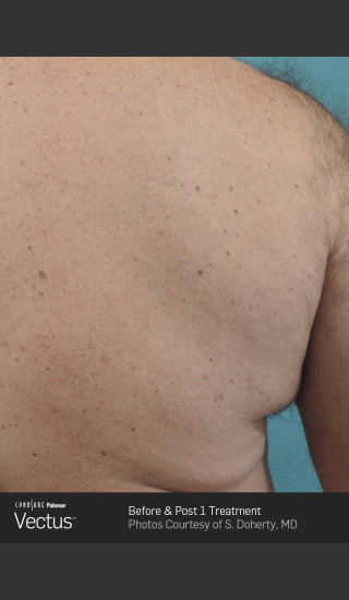 After Photo for Hair Removal of Back with Vectus -  - Prejuvenation