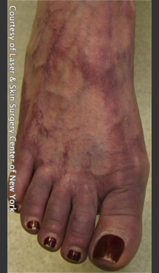 Before Photo for Treatment of Foot Leg Veins -  - Prejuvenation