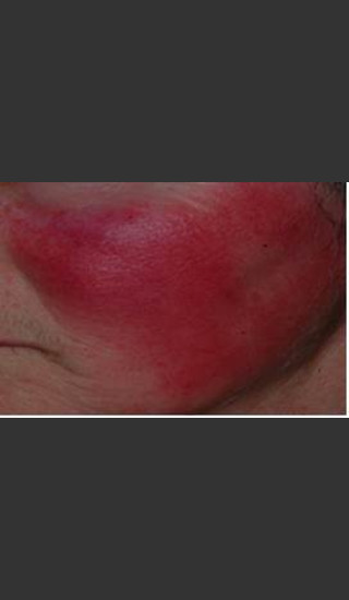 Before Photo for IPL Rosacea Treatment #16 - Harvey H. Jay, M.D. - Prejuvenation
