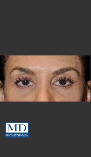 After Photo for Midfacial Filler 136 - Jill S. Waibel, MD - Prejuvenation