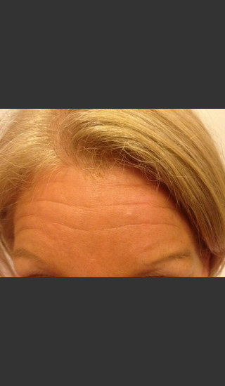 Before Photo for Before & After Botox - Janell Ocampo - Prejuvenation
