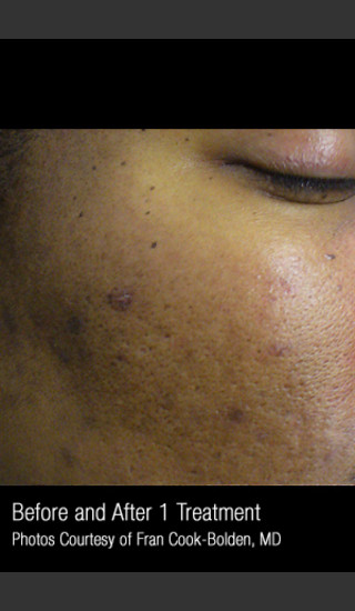 Before Photo for Treatment of Facial Pigmentation #331 -  - Prejuvenation