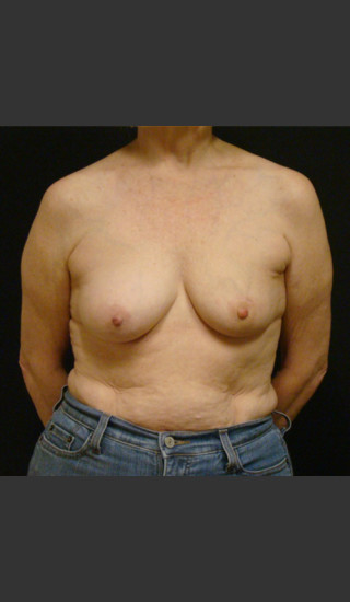 Before Photo for Breast Augmentation with a Lift - Gallaher Plastic Surgery & Spa MD - Prejuvenation