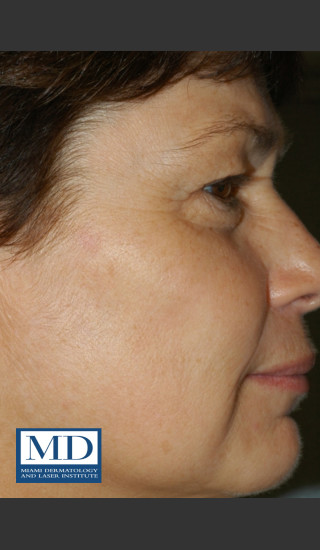 After Photo for Brown Spots Treatment 114 - Jill S. Waibel, MD - Prejuvenation