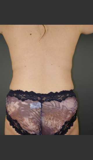 After Photo for Liposuction #44 Back View - Dr. David Amron - Prejuvenation