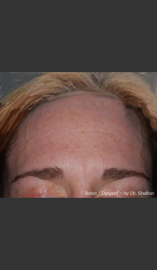 Before Photo for Treatment of Forehead Creases - Ron M. Shelton, M.D. - Prejuvenation