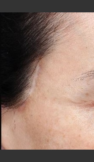 Before Photo for Scar on right and left temple at hairline  - Paul M. Friedman, M.D. - Prejuvenation