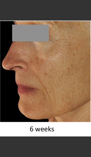 After Photo for DefenAge Skincare Clinical Power Trio - Amy Forman Taub, MD - Prejuvenation