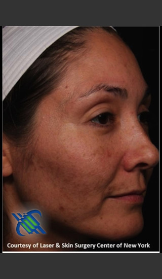Before Photo for Treatment of Melasma on the Right Side - Roy G. Geronemus, M.D. - Prejuvenation