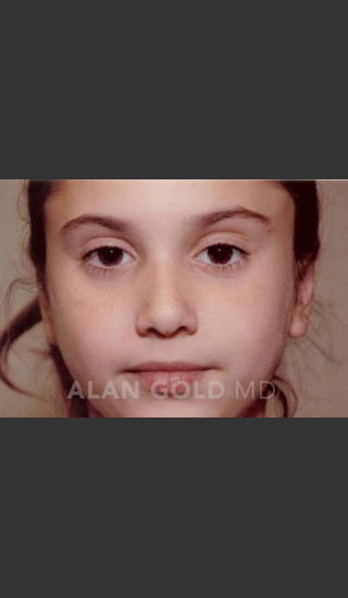After Photo for Otoplasty Case 887 - Alan Gold MD - Prejuvenation