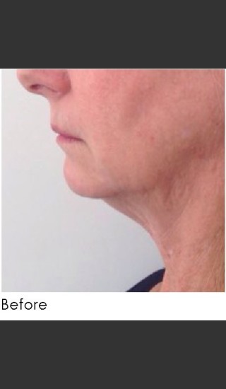 Before Photo for Kybella and Filler for Jawline Definition  - Annie Chiu, MD - Prejuvenation