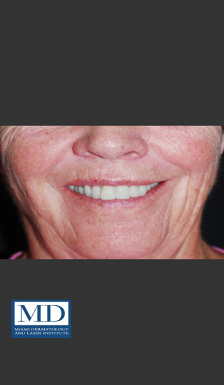 After Photo for Neurotoxin Gummy Smile 129 - Jill S. Waibel, MD - Prejuvenation