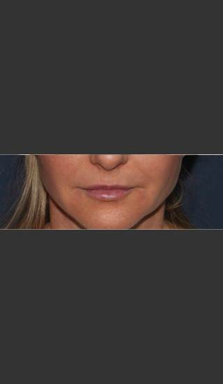 After Photo for Lip Augmentation - Mitchel P. Goldman M.D. - Prejuvenation
