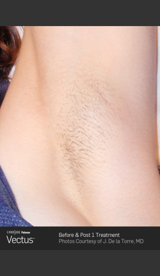 After Photo for Hair Removal of Under Arms with Vectus -  - Prejuvenation