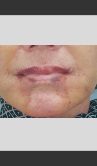 After Photo for Vbeam Laser of Post-operative Bruising -  - Prejuvenation