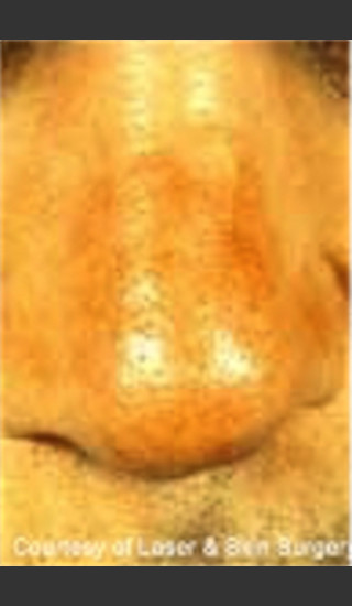 Before Photo for Treatment of Nose Blood Vessels -  - Prejuvenation