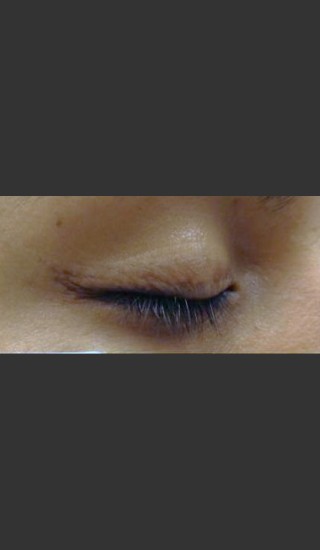 After Photo for Treatment of Permanent Eye Liner - Roy G. Geronemus, M.D. - Prejuvenation