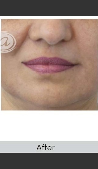 After Photo for Marionette Line Filler - Annie Chiu, MD - Prejuvenation