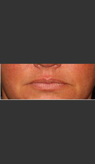 Before Photo for Lip Plumping Treatment - William F. Groff, M.D. - Prejuvenation