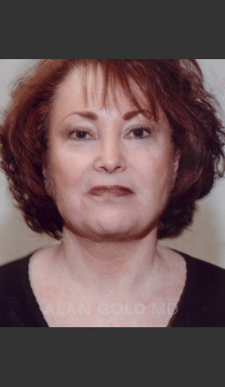 After Photo for Liposuction of Neck 89 - Alan Gold MD - Prejuvenation