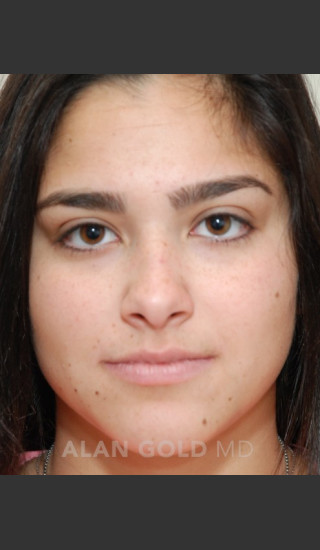 Before Photo for Rhinoplasty 1676 - Alan Gold MD - Prejuvenation