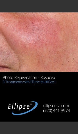 Before Photo for Before and After 3 Treatments of Rosacea -  - Prejuvenation