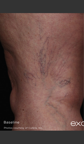Before Photo for Back of Thigh Leg Vein Clearance  -  - Prejuvenation