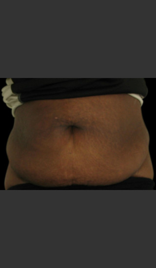 Before Photo for Body Contouring Treatment #115 -  - Prejuvenation