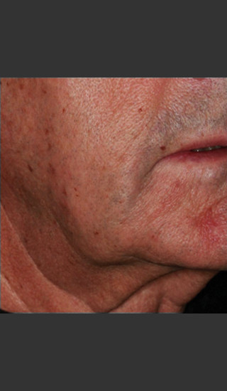 Before Photo for Infini Rhytides Treatment #18 -  - Prejuvenation