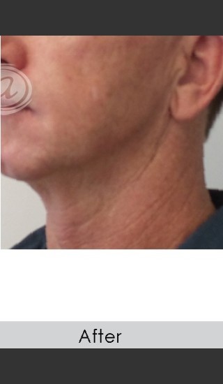 After Photo for Male Jawline Enhancement with Radiesse - Annie Chiu, MD - Prejuvenation