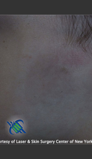 After Photo for Treatment of Facial  Caf_ au Lait - Roy G. Geronemus, M.D. - Prejuvenation