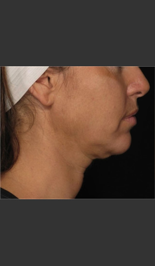 Before Photo for Treatment of Neck with Laser Liposuction -  - Prejuvenation