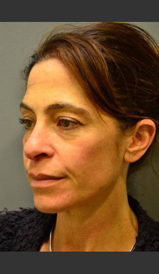 Before Photo for C02 & Thermage Treatment #47 - Dr. David Amron - Prejuvenation