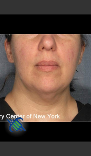 After Photo for Laser Liposuction Submental Fat Treatment - Roy G. Geronemus, M.D. - Prejuvenation