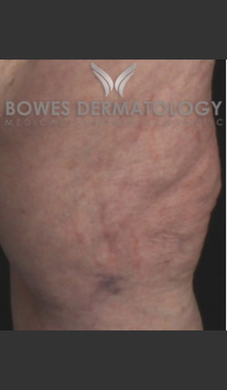 After Photo for Spider Vein Treatment - Leyda Elizabeth Bowes, M.D. - Prejuvenation