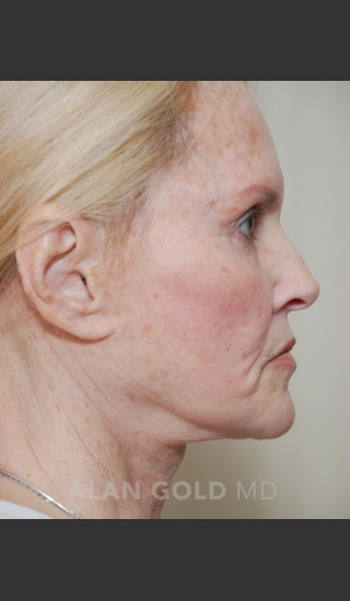 Before Photo for Rhytidectomy (Facelift) 1753 Side View - Alan Gold MD - Prejuvenation