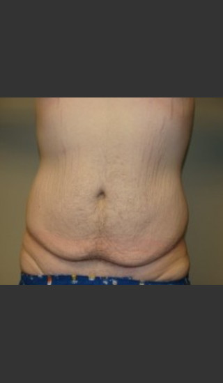 Before Photo for Belt Lipectomy 7986 - Sanjay Grover MD FACS - Prejuvenation