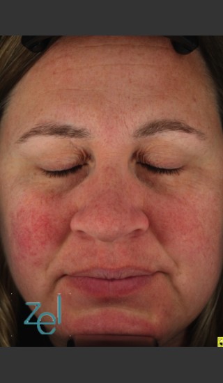 Before Photo for Treatment of Facial Redness  - Brian D. Zelickson, M.D. - Prejuvenation