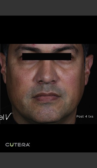 After Photo for Skin Revitalization of Male Face Before & After Photo -  - Prejuvenation