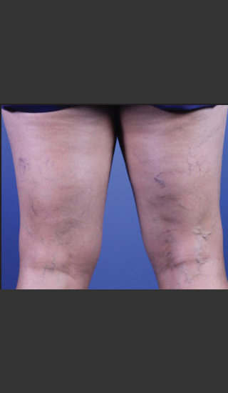 Before Photo for Sclerotherapy Treatment for Varicose Veins - Daniel Friedmann  - Prejuvenation